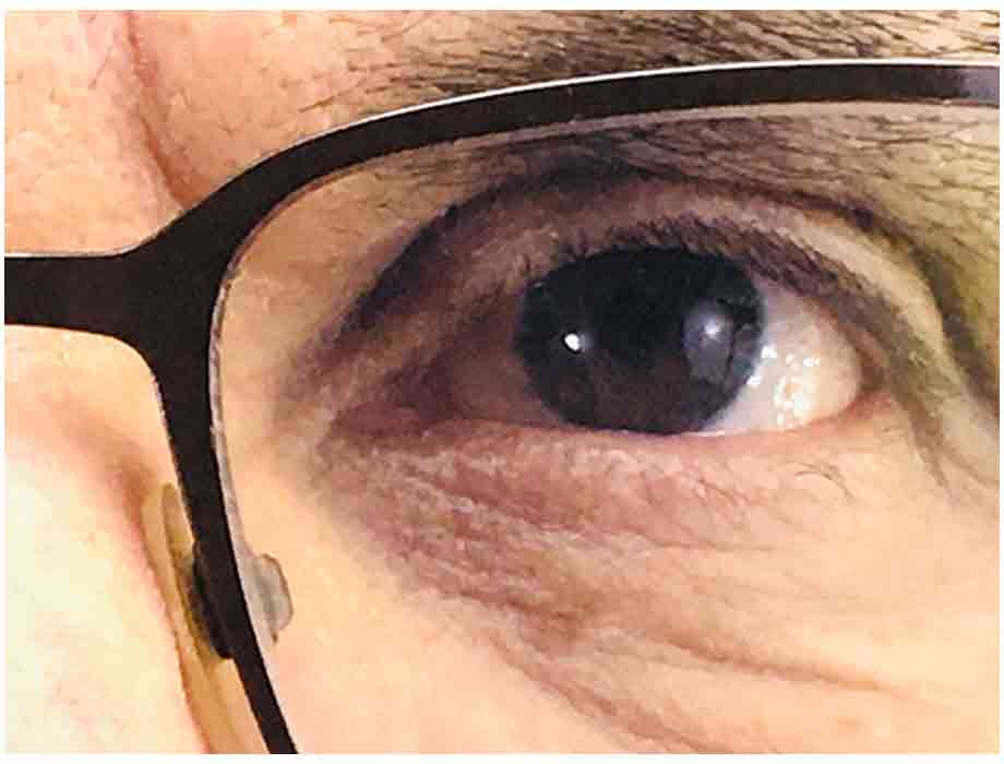 FDA emite alerta para gotas para los ojos por posible