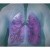 Amgen presenta nuevos datos de su tratamiento para cáncer de pulmón