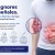 Más del 10% de los mexicanos presenta una hernia, pero muchos posponen su tratamiento durante meses o años