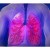 FDA autoriza terapia de MSD para tratar la hipertensión arterial pulmonar